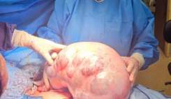 خارج‌ کردن توده ۱۰ کیلویی و ۴۰ سانتی‌متری از شکم یک بیمار