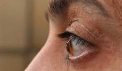 هشدار چشم‌پزشکان: شیوع قوز قرنیه در ایران دو برابر میانگین جهانی!