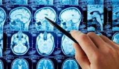 داروی جدید تومورهای مغزی "تینستاموستین" در فهرست داروهای اورفان قرار گرفت