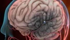 هشدار درباره جهش قیمت داروهای سکته مغزی؛ درمان تعطیل می‌شود