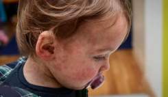 افزایش نگران‌کننده سرخک در آمریکا؛ بیشترین کودکان مبتلا واکسن نزده‌اند