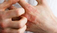 چگونه از بروز مشکلات پوستی پیشگیری کنیم